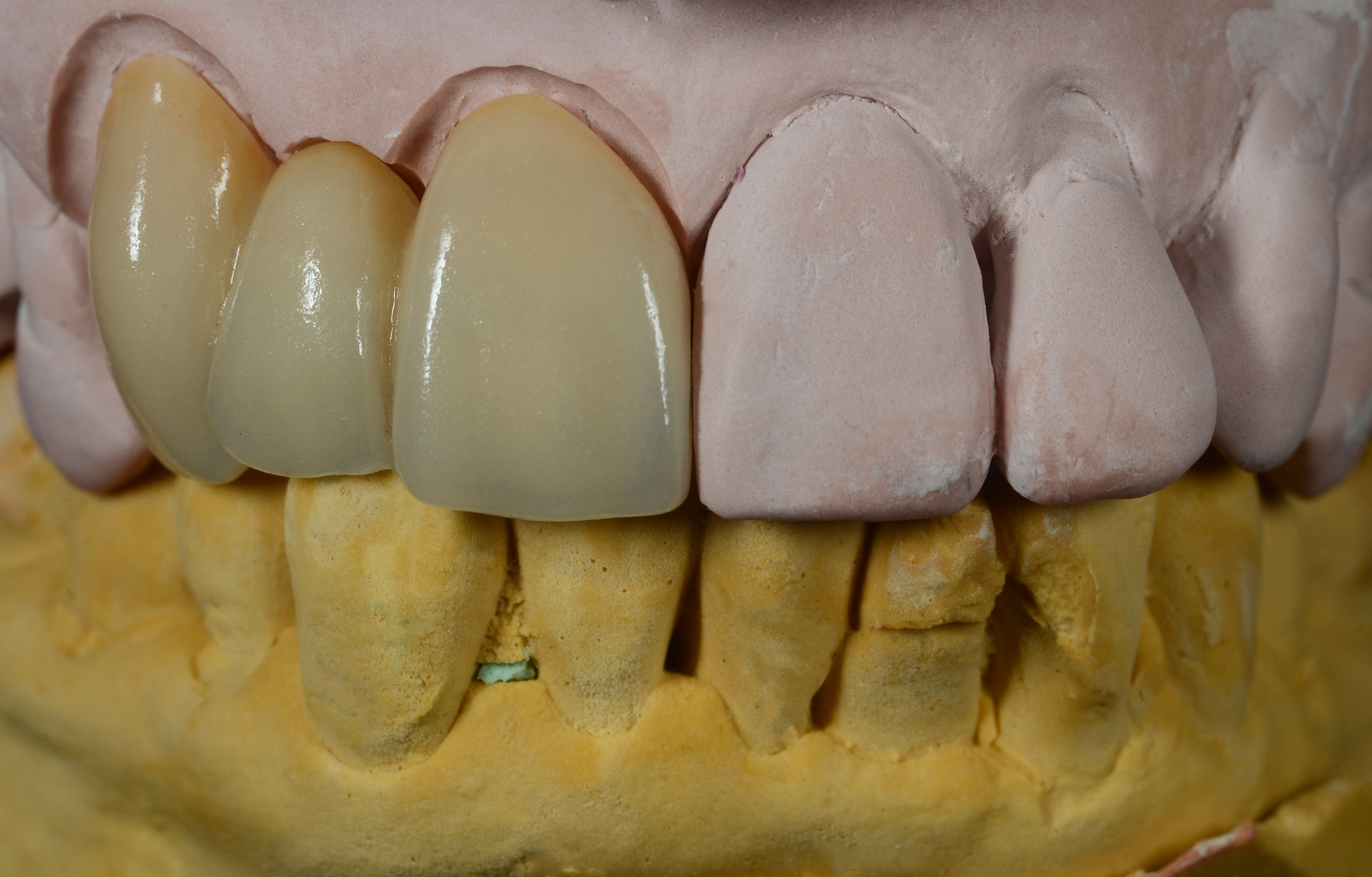 Sagemax Zirconia Bridge with Layering